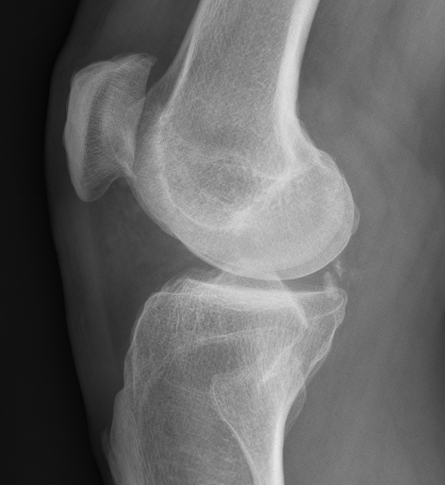 Loose Body Knee OA Small Posterior